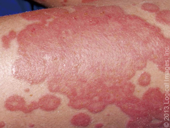 圖2斑塊狀乾癬呈現大塊浸潤性紅斑的斑塊邊界清晰圖片來源UpToDate醫學網站